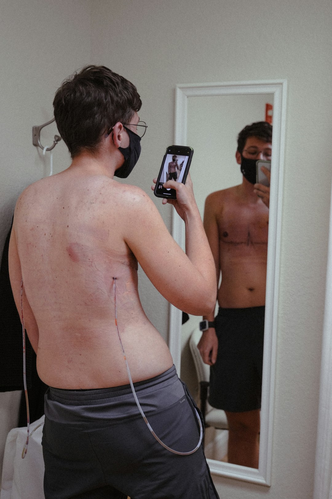 microneedling recovery photos related to microneedling recovery photos